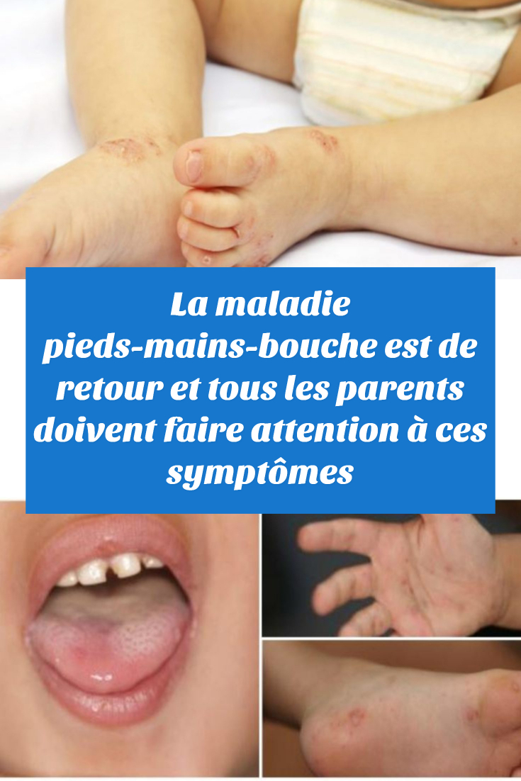 La maladie pieds-mains-bouche est de retour et tous les parents doivent faire attention à ces symptômes