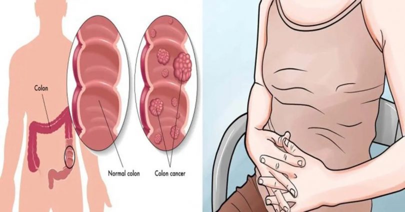 Le cancer du colon est un tueur silencieux : 5 signes à repérer