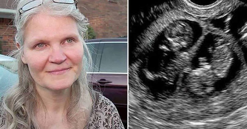 Cette femme de 42 ans est enceinte de triplés, elle accouche de quadruplés